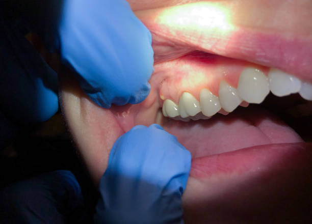 Best Dentist for Tooth Abscess  in The Woodlands, TX